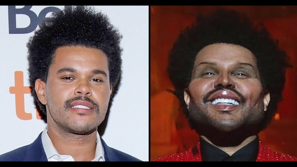 The Weeknd Plastic Surgery